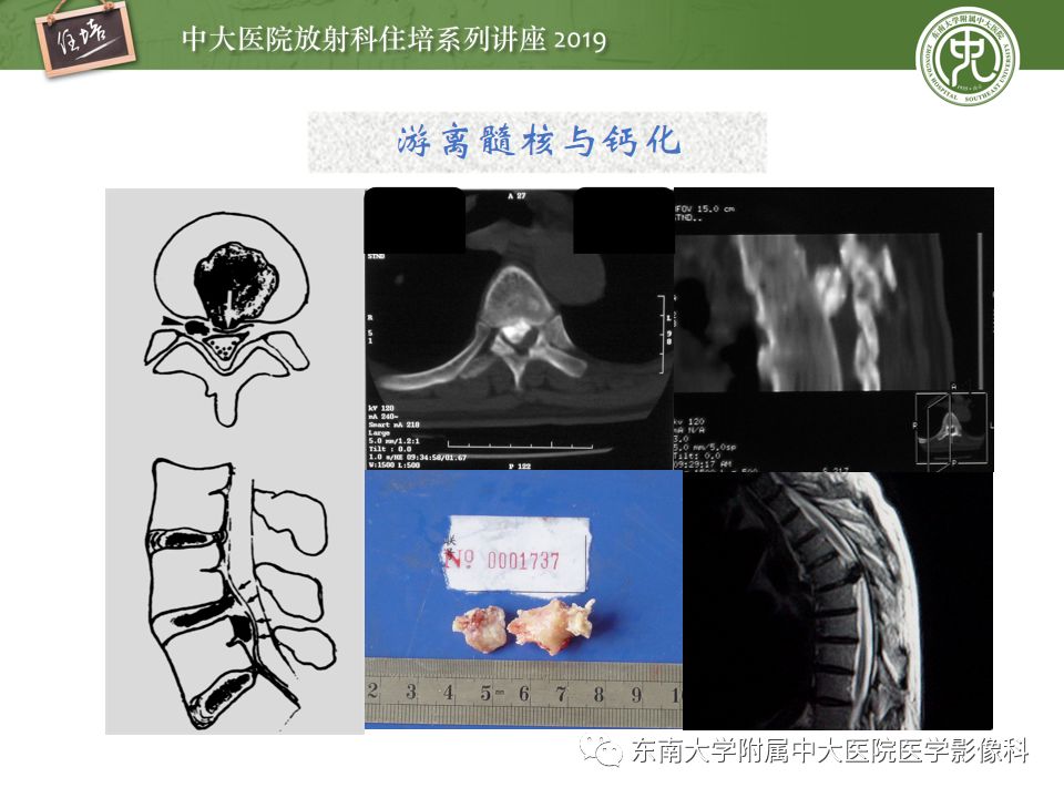 【PPT】椎间盘病变的影像分型及评价