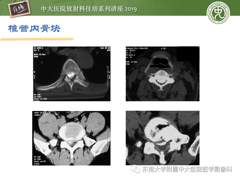【PPT】椎间盘病变的影像分型及评价