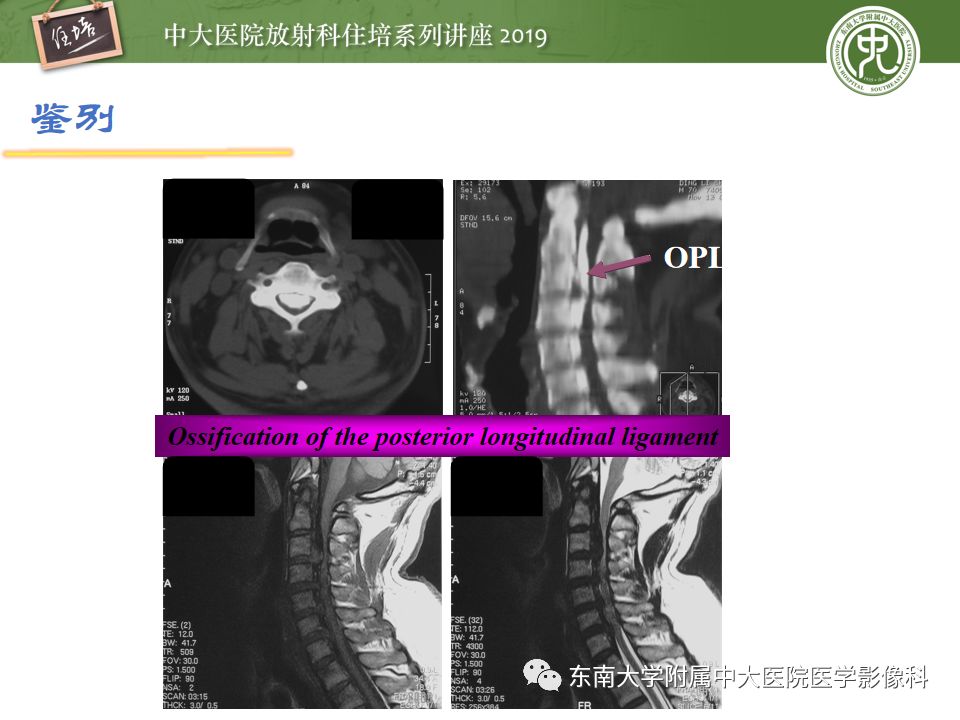 【PPT】椎间盘病变的影像分型及评价