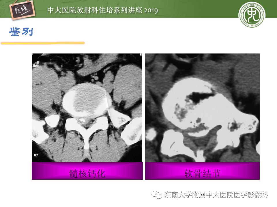 【PPT】椎间盘病变的影像分型及评价