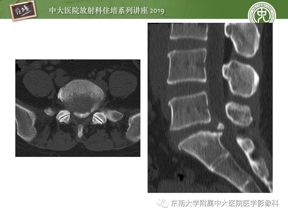 【PPT】椎间盘病变的影像分型及评价