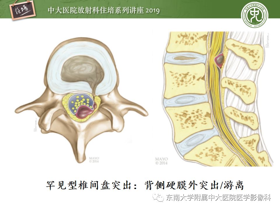 【PPT】椎间盘病变的影像分型及评价