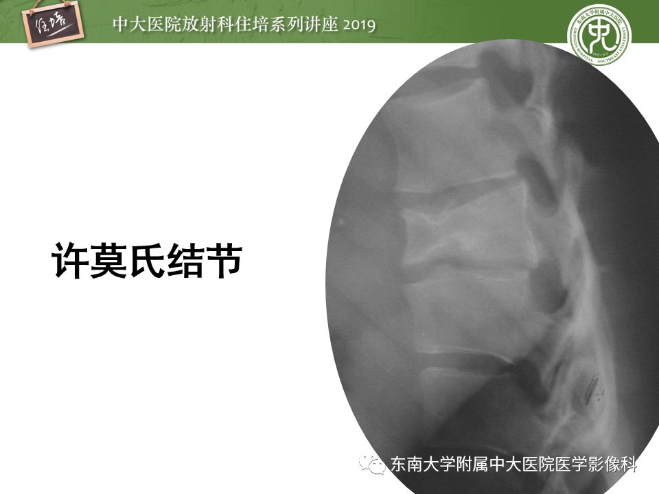 【PPT】椎间盘病变的影像分型及评价