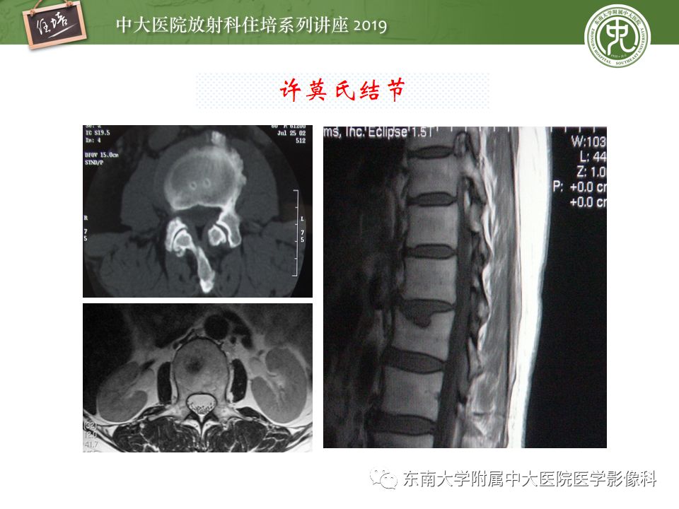 【PPT】椎间盘病变的影像分型及评价