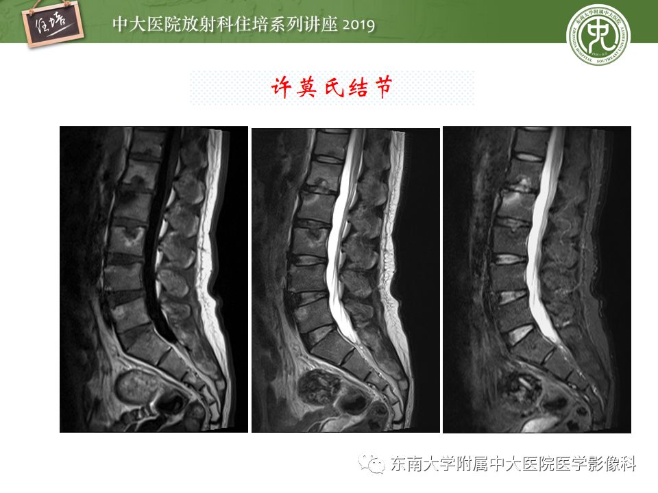 【PPT】椎间盘病变的影像分型及评价