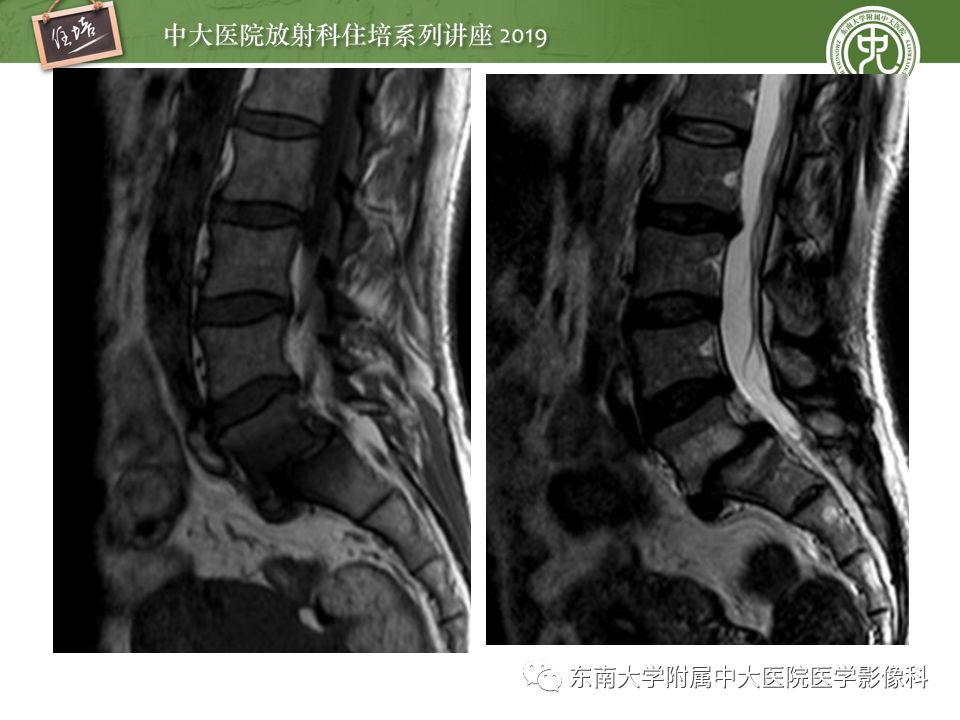 【PPT】椎间盘病变的影像分型及评价