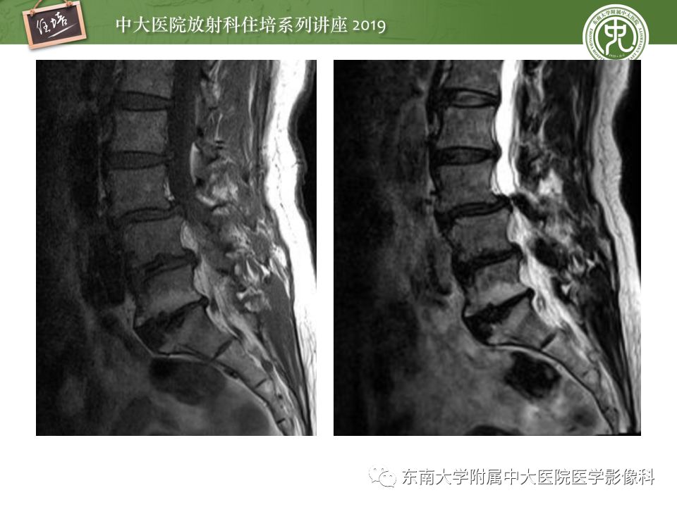 【PPT】椎间盘病变的影像分型及评价