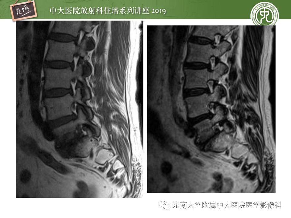 【PPT】椎间盘病变的影像分型及评价