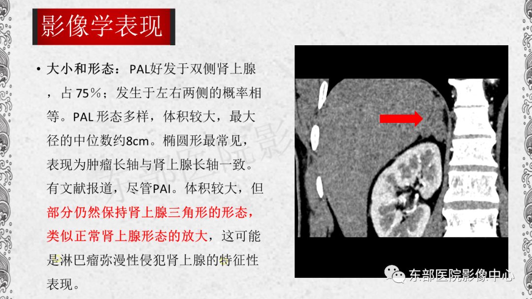 【PPT】肾上腺淋巴瘤