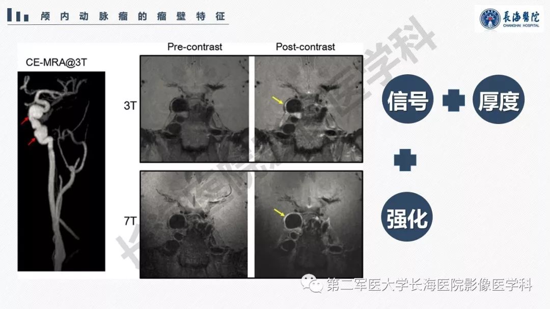 【PPT】高分辨率MRI管壁成像在颅内动脉瘤风险评估中的应用