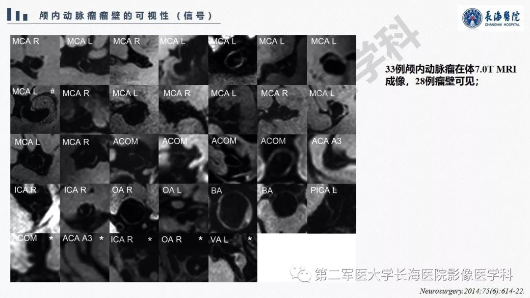 【PPT】高分辨率MRI管壁成像在颅内动脉瘤风险评估中的应用