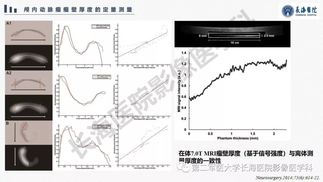 【PPT】高分辨率MRI管壁成像在颅内动脉瘤风险评估中的应用