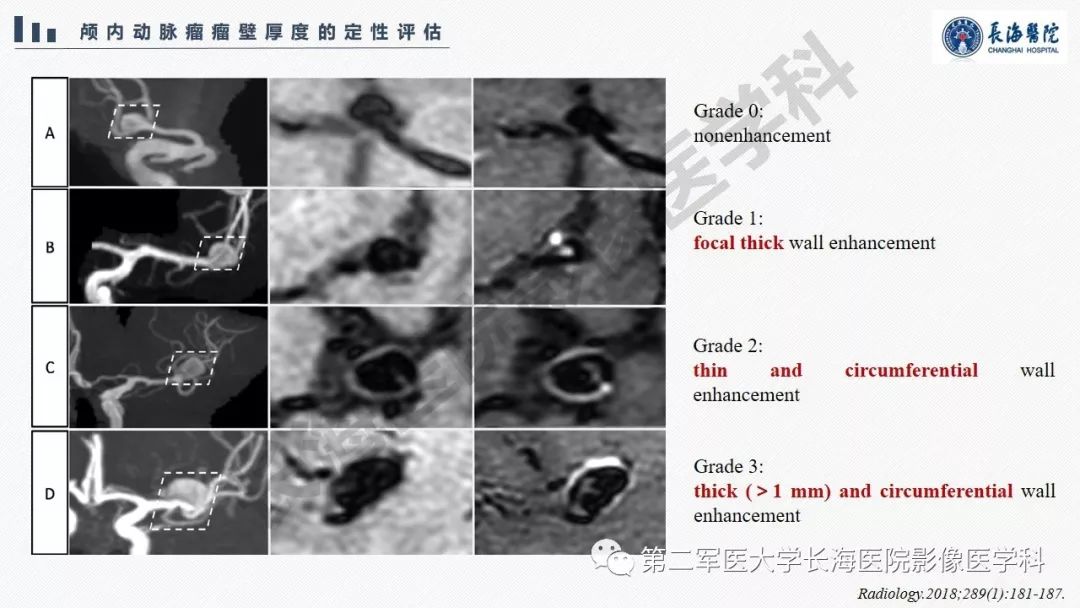 【PPT】高分辨率MRI管壁成像在颅内动脉瘤风险评估中的应用