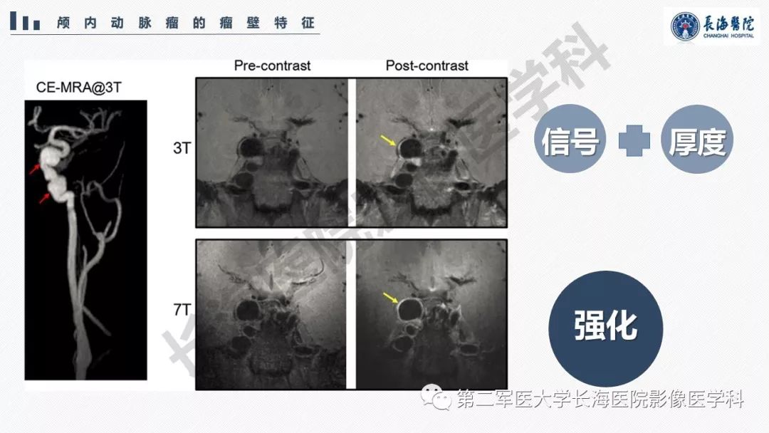 【PPT】高分辨率MRI管壁成像在颅内动脉瘤风险评估中的应用