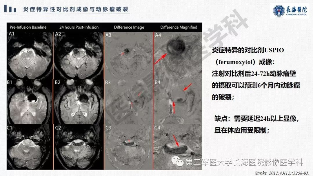【PPT】高分辨率MRI管壁成像在颅内动脉瘤风险评估中的应用
