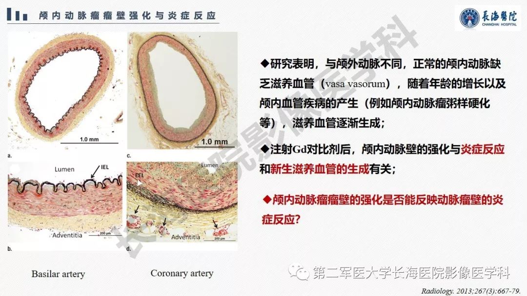 【PPT】高分辨率MRI管壁成像在颅内动脉瘤风险评估中的应用