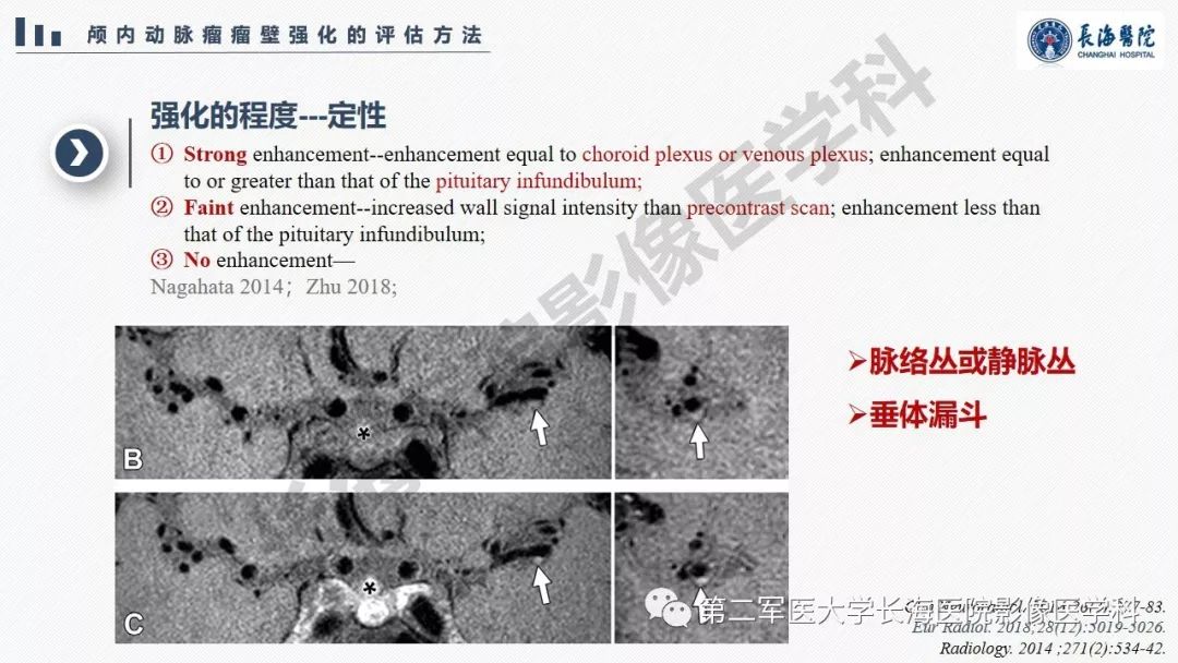 【PPT】高分辨率MRI管壁成像在颅内动脉瘤风险评估中的应用