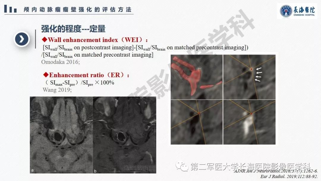 【PPT】高分辨率MRI管壁成像在颅内动脉瘤风险评估中的应用