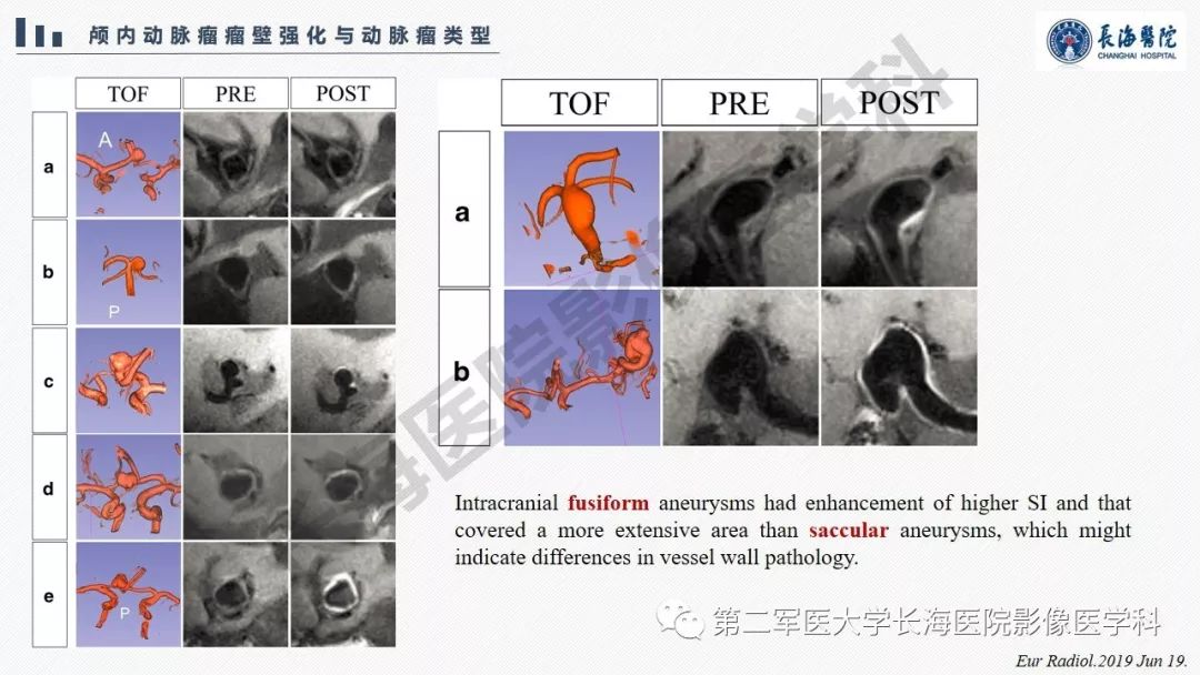 【PPT】高分辨率MRI管壁成像在颅内动脉瘤风险评估中的应用