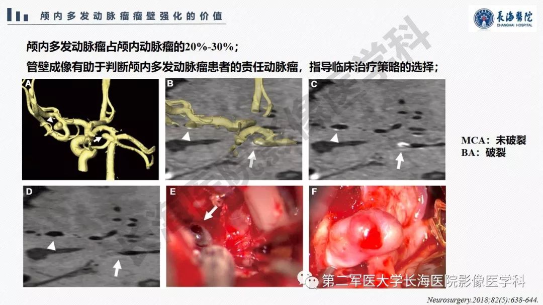 【PPT】高分辨率MRI管壁成像在颅内动脉瘤风险评估中的应用