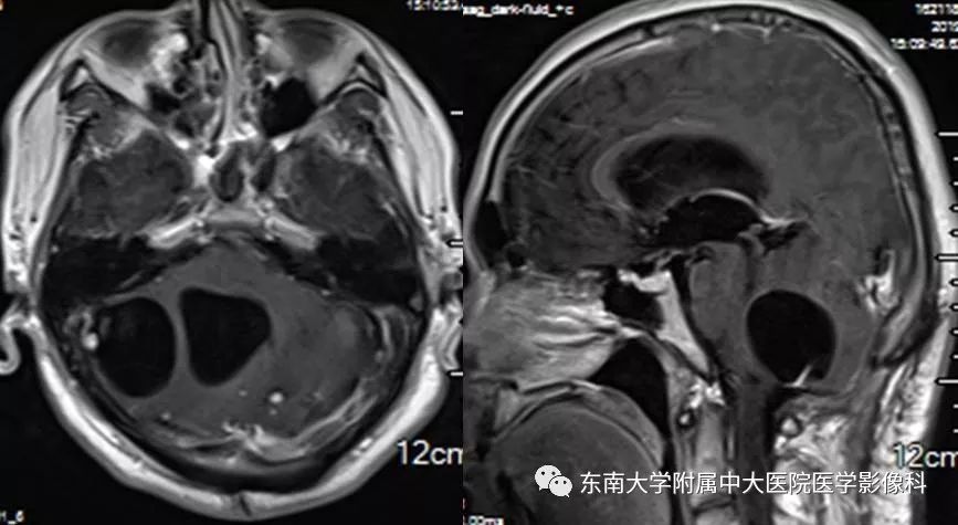 【PPT】VHL综合征