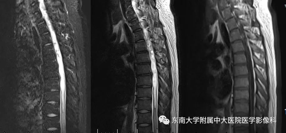 【PPT】VHL综合征