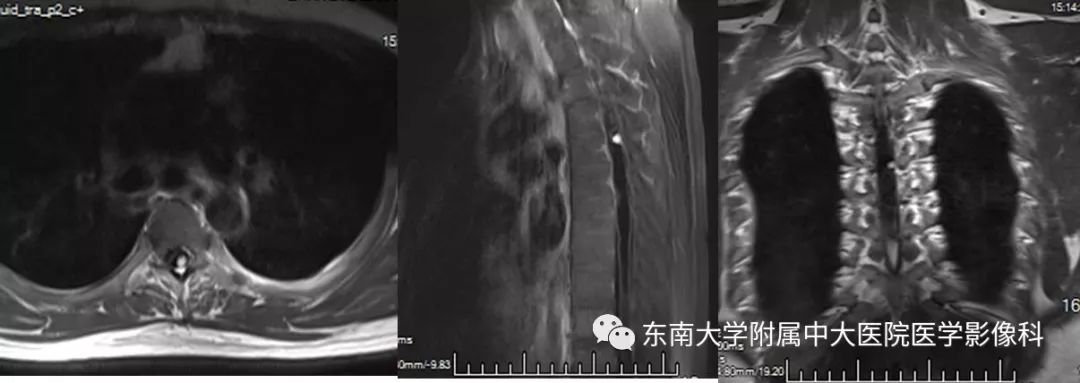 【PPT】VHL综合征