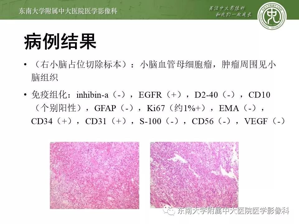 【PPT】VHL综合征