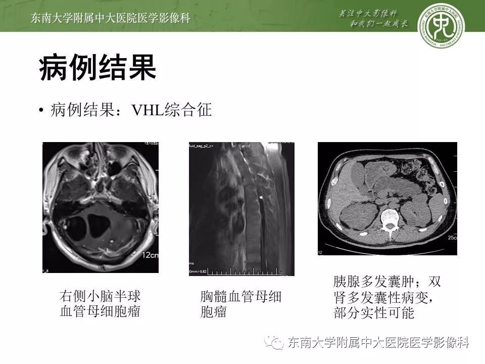 【PPT】VHL综合征