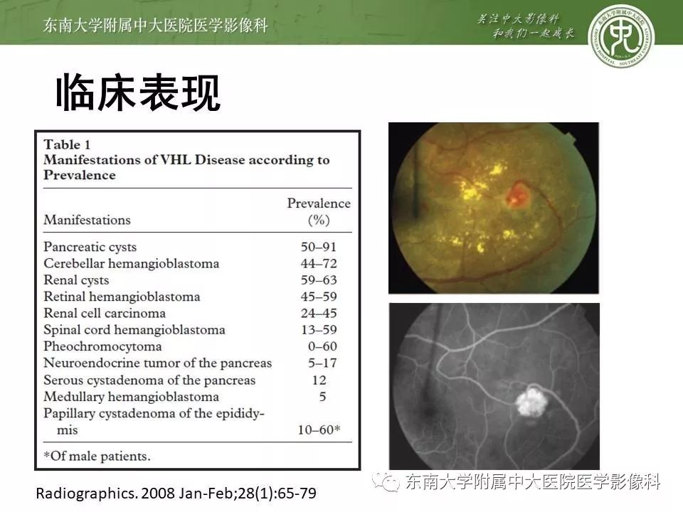 【PPT】VHL综合征