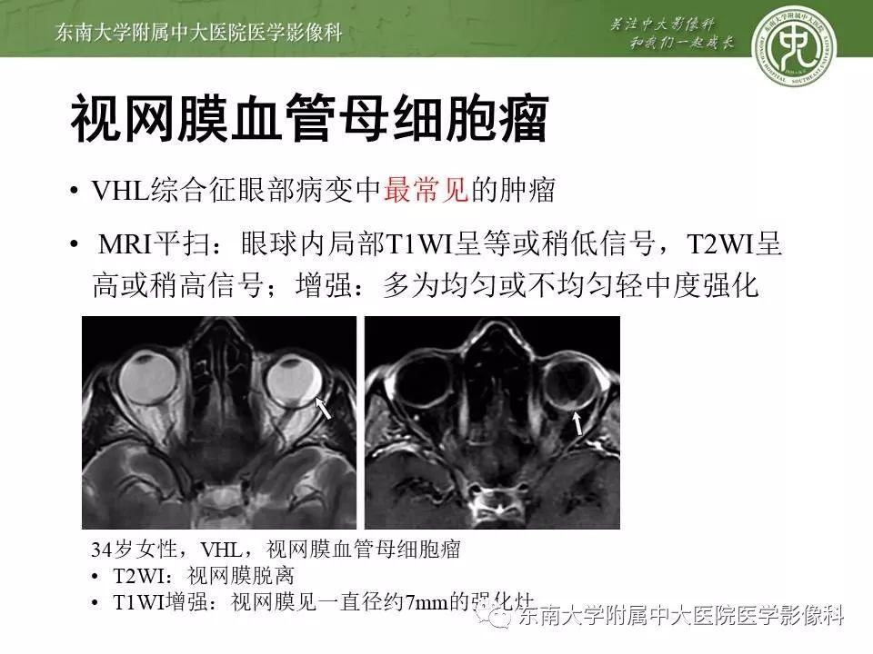 【PPT】VHL综合征