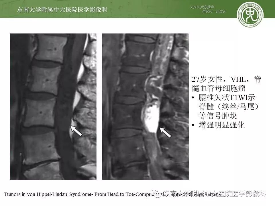 【PPT】VHL综合征