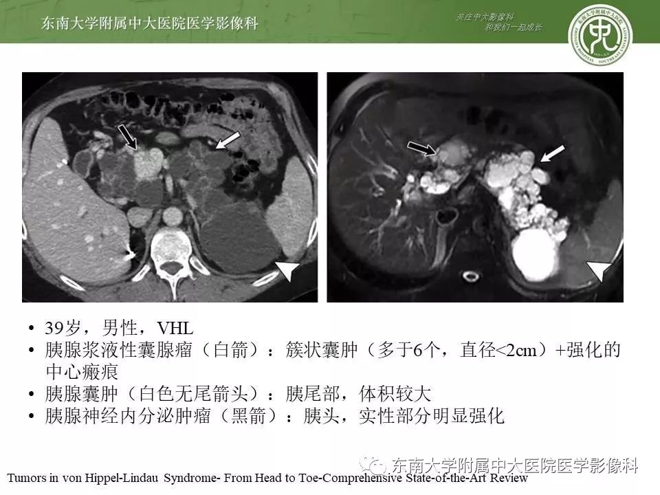 【PPT】VHL综合征