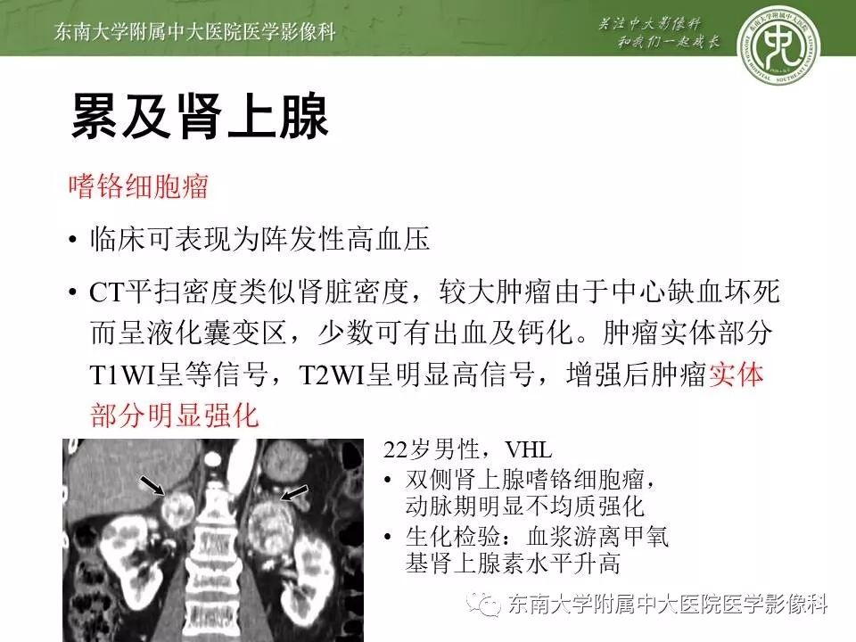 【PPT】VHL综合征