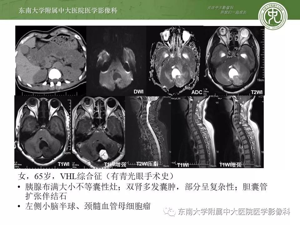 【PPT】VHL综合征