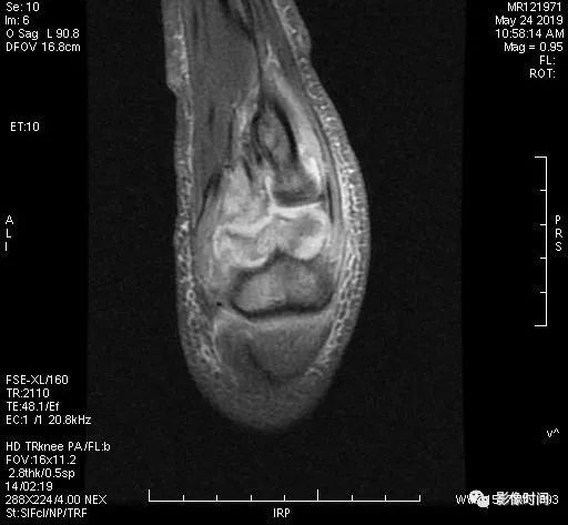 【病例】化脓性关节炎3例MR影像 【病例】化脓性关节炎3例MR影像