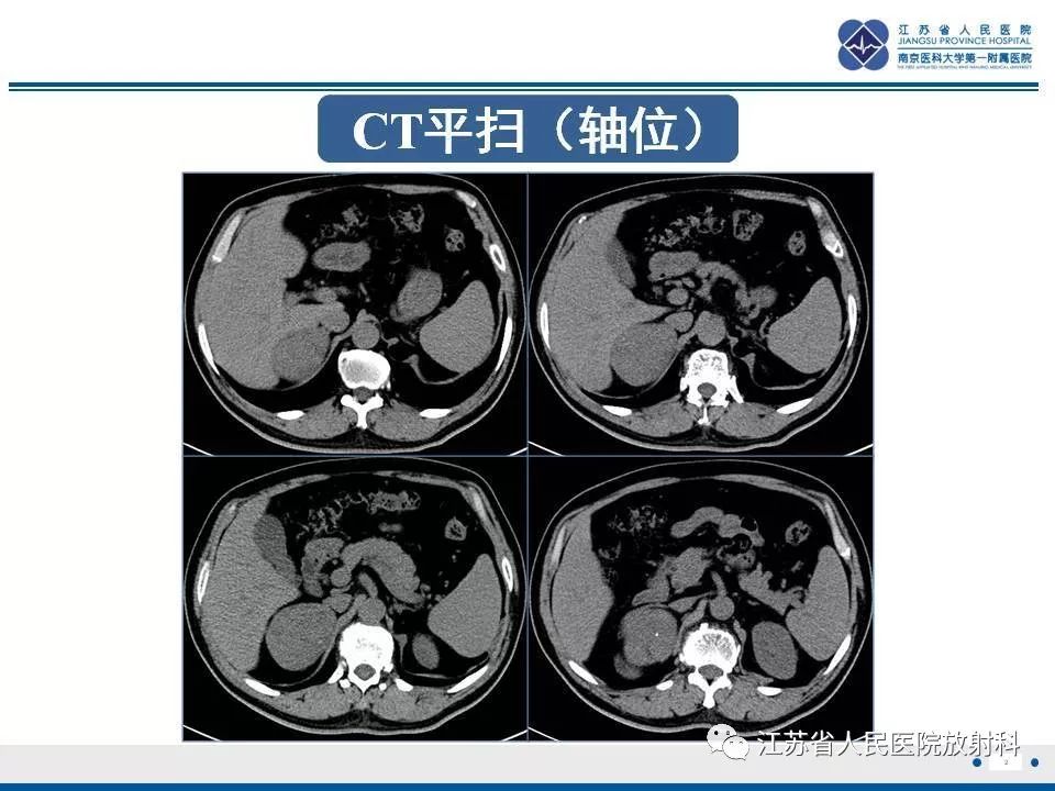 【PPT】肾上腺血管瘤