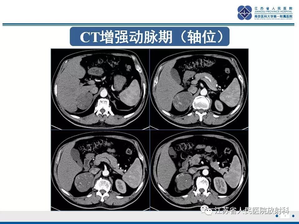 【PPT】肾上腺血管瘤