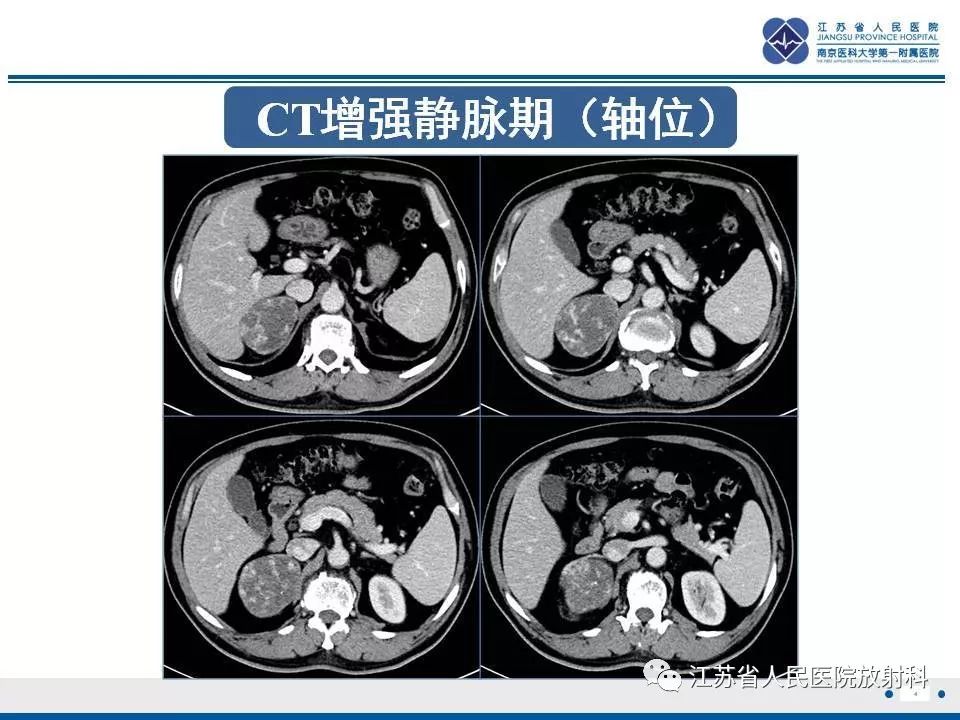 【PPT】肾上腺血管瘤
