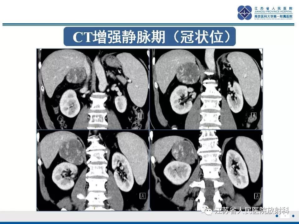 【PPT】肾上腺血管瘤