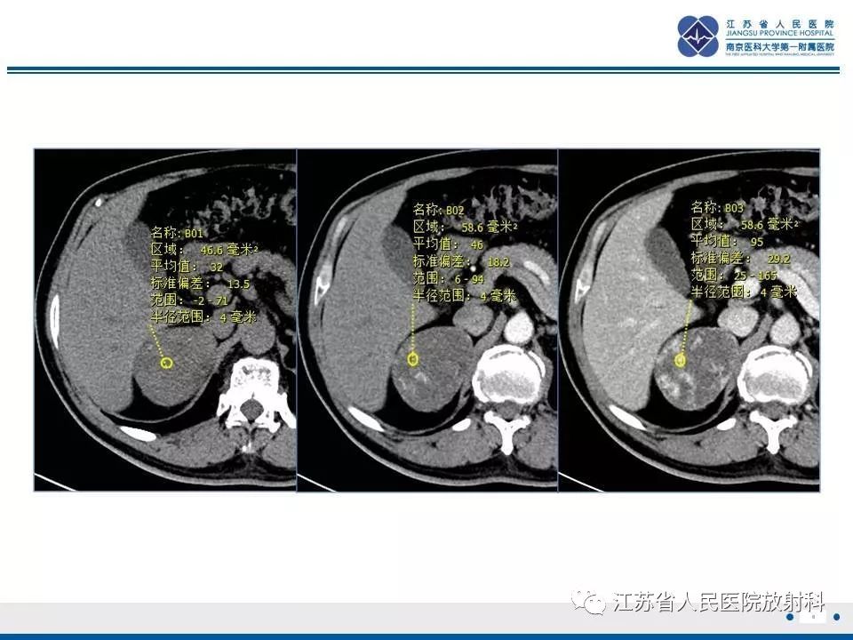 【PPT】肾上腺血管瘤