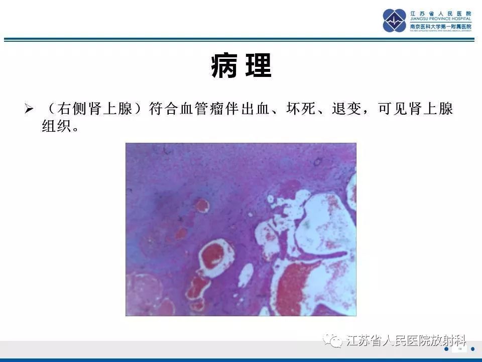 【PPT】肾上腺血管瘤