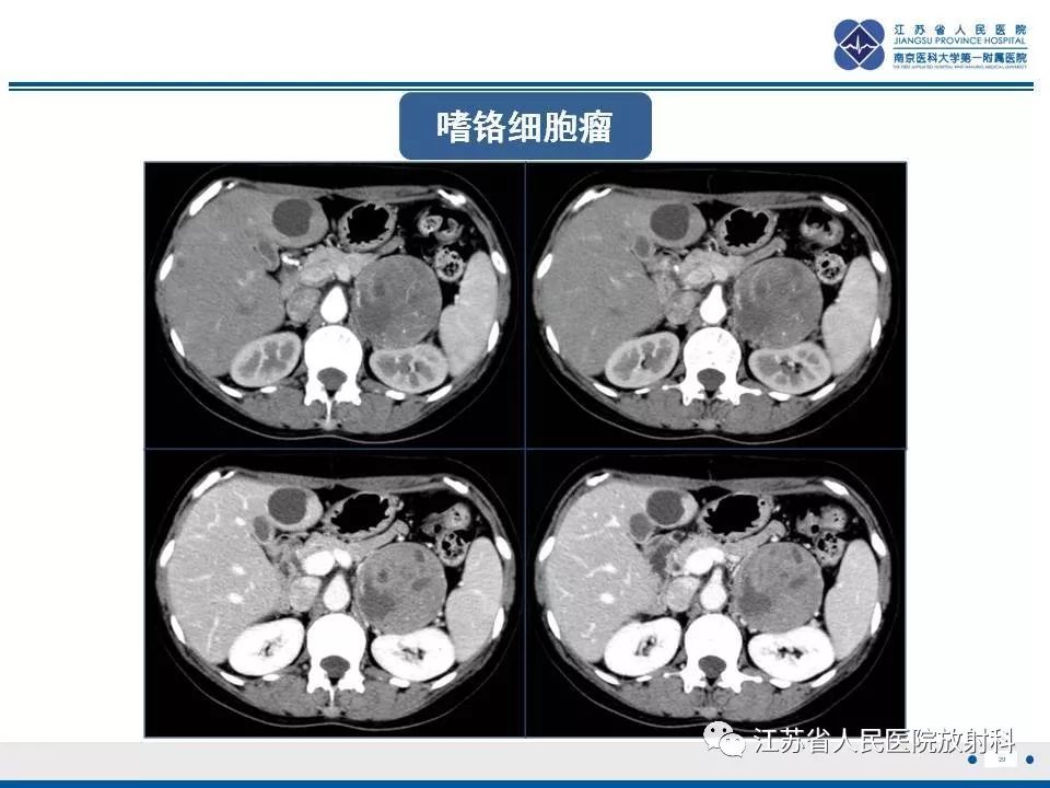【PPT】肾上腺血管瘤