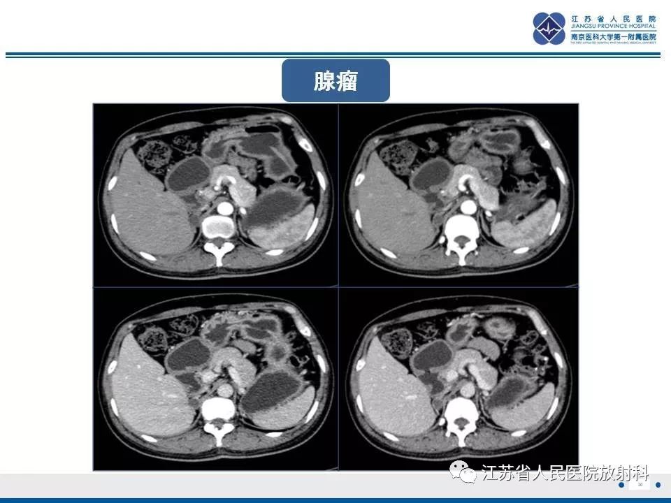【PPT】肾上腺血管瘤