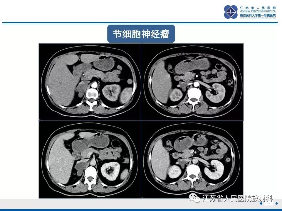 【PPT】肾上腺血管瘤