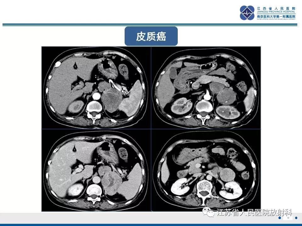 【PPT】肾上腺血管瘤