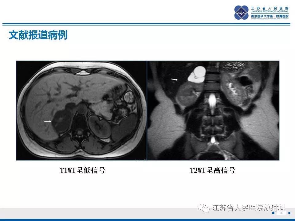 【PPT】肾上腺血管瘤