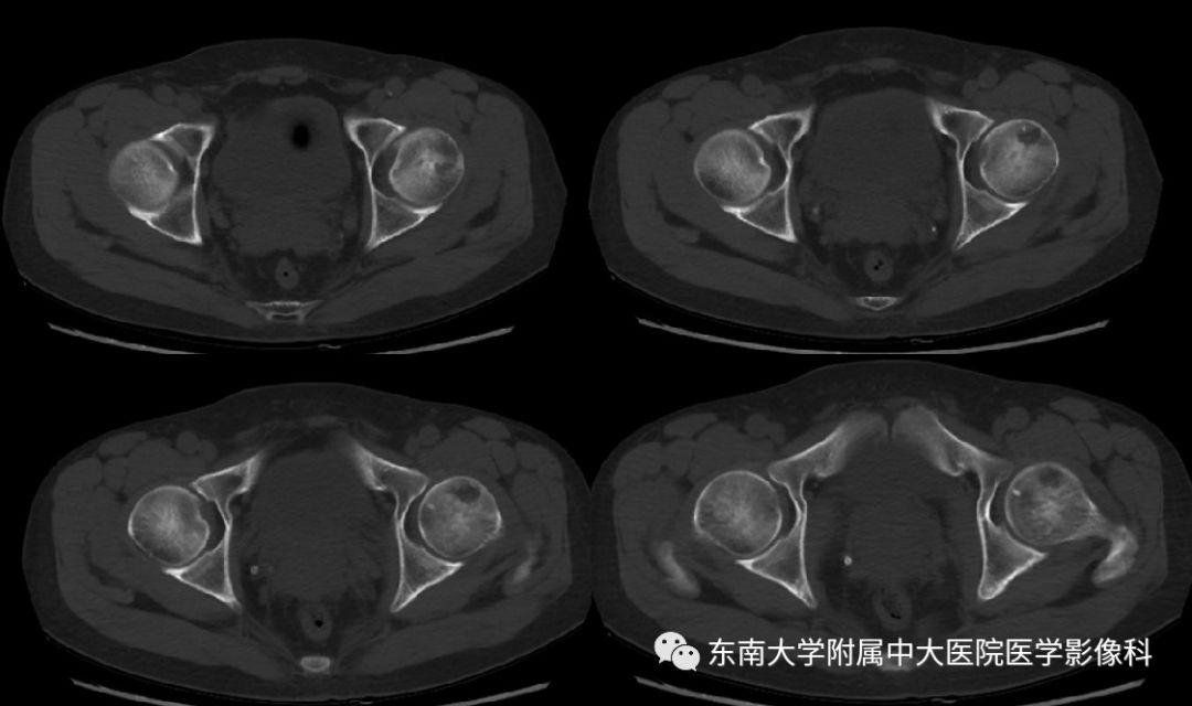【PPT】股骨头囊性变机制及其鉴别诊断