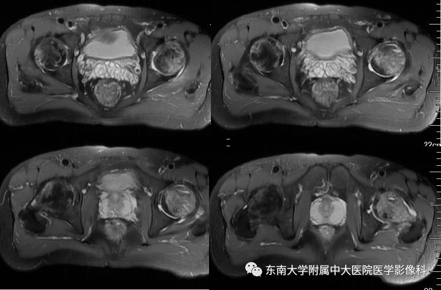 【PPT】股骨头囊性变机制及其鉴别诊断