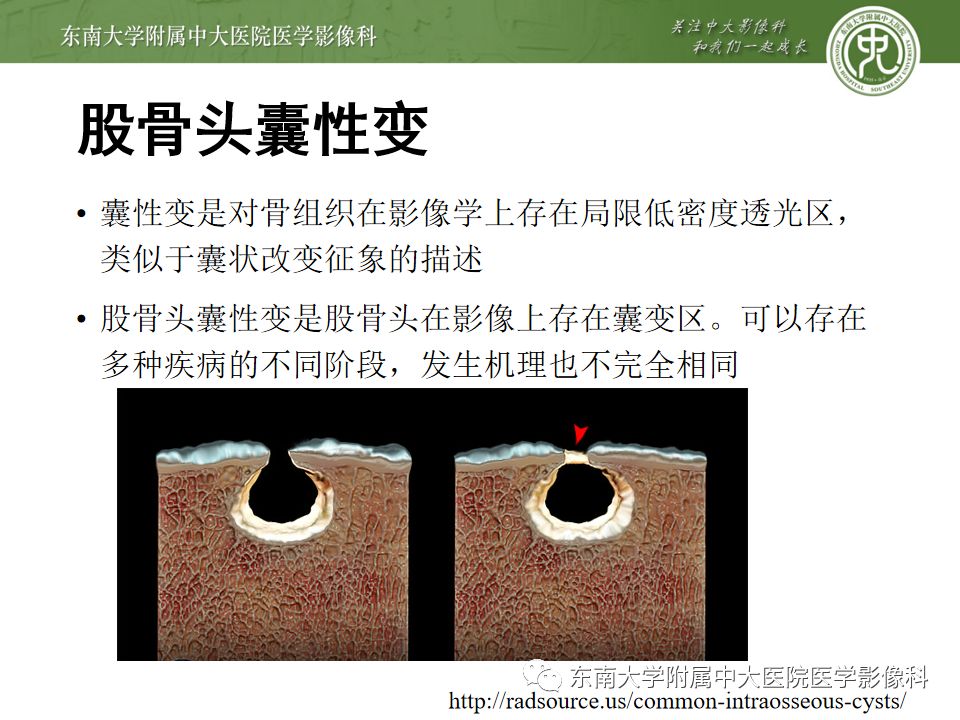 【PPT】股骨头囊性变机制及其鉴别诊断